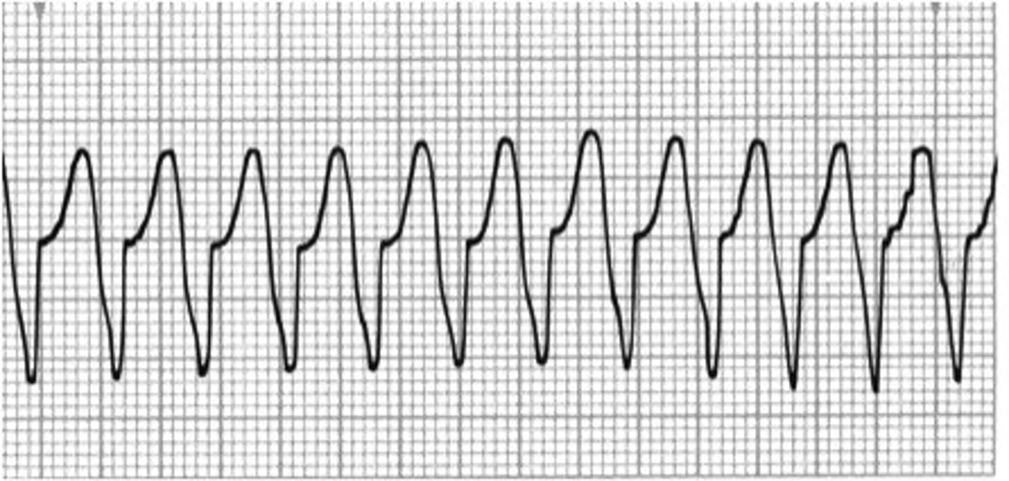 <p>Rapid heartbeat</p><p>-if rapid enough it will not allow the hearts chambers to fill with enough blood between beats to produce blood flow sufficient enough to meet the body's needs</p>