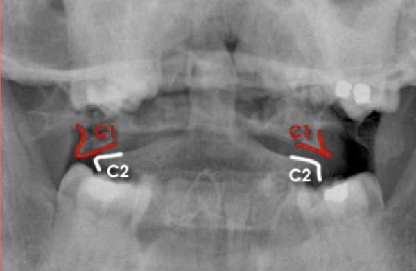<p>What type of fracture is this at C1</p>