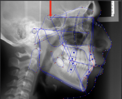 <p>which anatomical landmark:</p><p>- Center of the pituitary fossa (sella turcica) of the sphenoid bone</p>