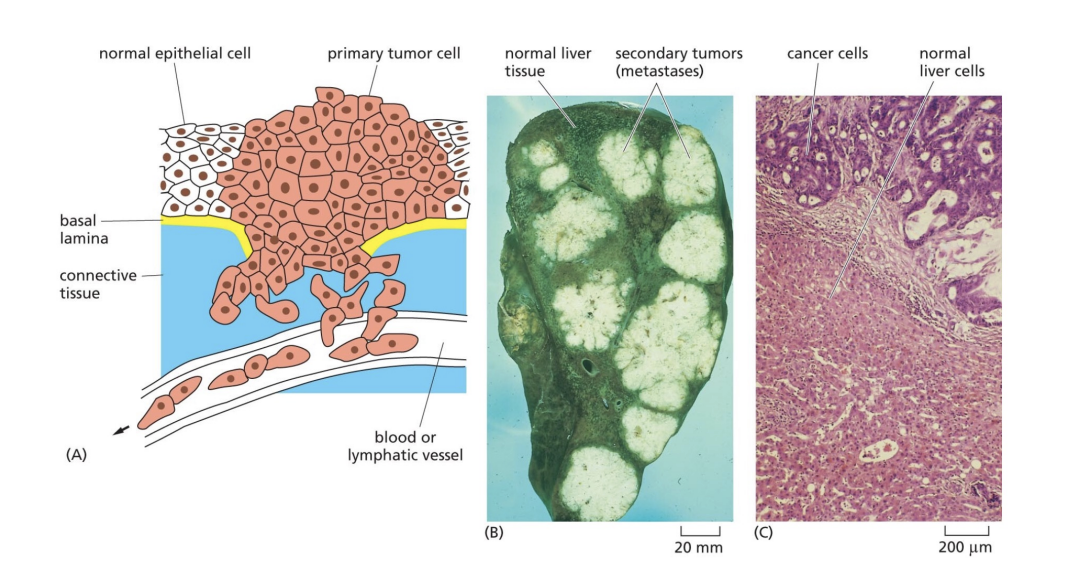 <p>invade surrounding tissues and metastasize to distnace sites</p>
