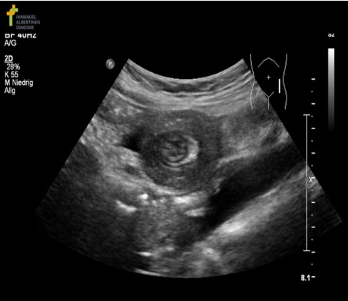 <p>A 3yr old is scanned due to vomiting and a palpable lump in the abdomen.</p><p class="p1">These findings are most suggestive of:</p><p class="p1">A. Pyloric stenosis</p><p class="p1">B. Biliary ascaris</p><p class="p1">C. Intussusception</p><p class="p1">D. Appendicitis</p>