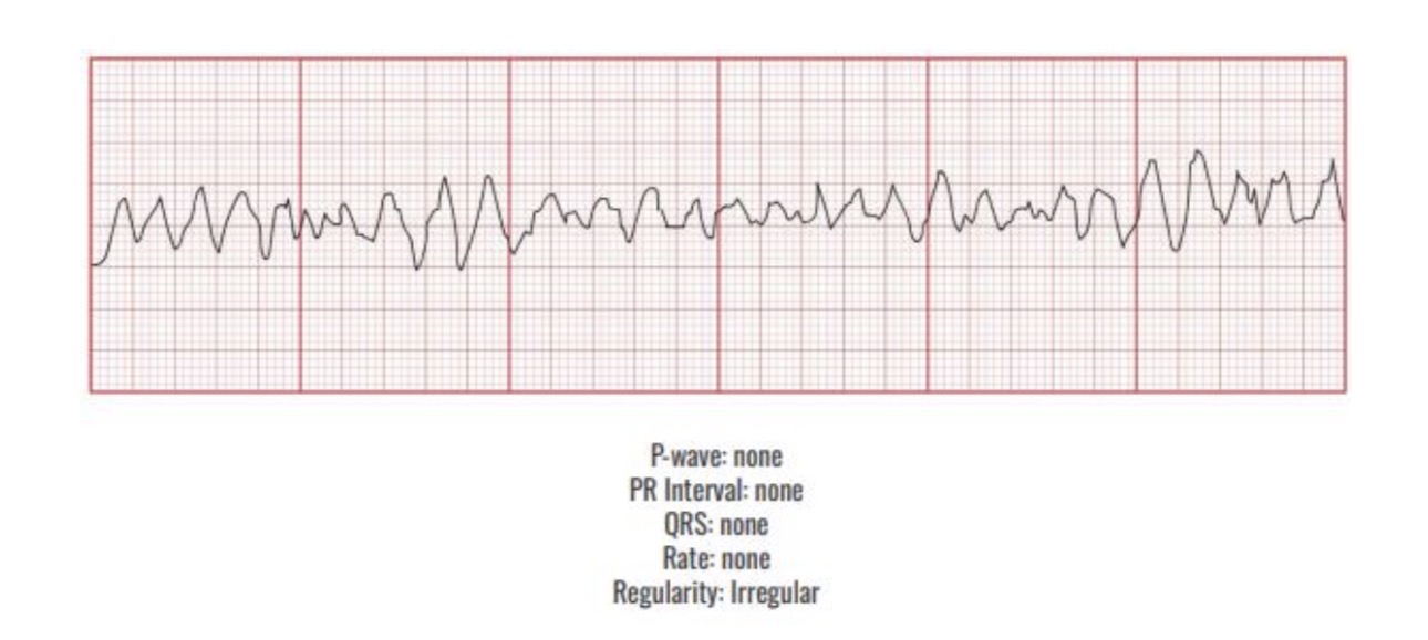 <p>Causes</p><p>MI</p><p>Ischemia</p><p><span><span>-Hypoxia</span></span></p><p><span><span>-Acidosis</span></span></p><p><span><span>-Hypokalemia</span></span></p><p><span><span>-Hypotension</span></span></p><p><span><span>-Most common sudden cause of</span></span></p><p><span><span>death</span></span></p><p></p><p><span><span>Interventions</span></span></p><p><span><span>Cpr</span></span></p><p><span><span>Defib</span></span></p><p><span><span>Epinephrine </span></span></p>