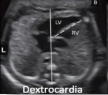 <ul><li><p>heart in <span style="color: red;">right chest </span>with <span style="color: red;">apex pointed to right</span> of thorax</p></li><li><p>can be associated with normal visceral situs, situs inversus, or situs ambiguous </p></li></ul><p></p>