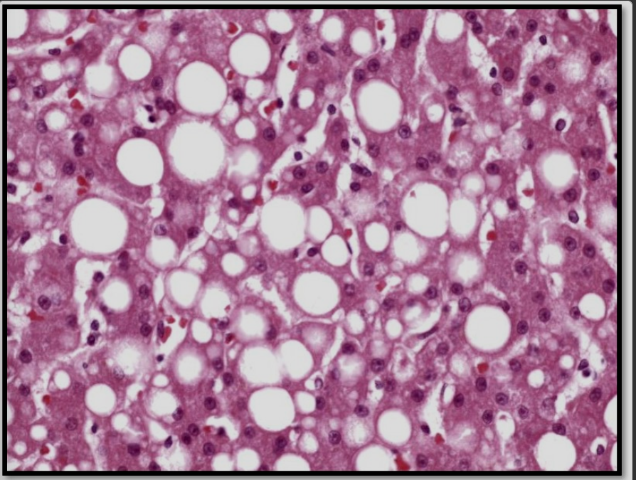 <p>fat vaculoes accumulate in the hepatocyte as clear circular spaces of various sized</p>