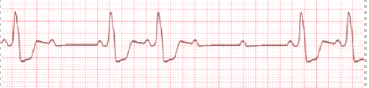 <ul><li><p class="Paragraph SCXW46524299 BCX8" style="text-align: left;"><span style="line-height: 20.85px;">Causes: anterior wall MI, CAD, cardiomyopathy </span></p></li></ul><ul><li><p class="Paragraph SCXW46524299 BCX8" style="text-align: left;"><span style="line-height: 20.85px;">Tx: artificial pacing </span></p></li></ul><p>In Mobitz II, the atria are working normally (P waves are present), but some electrical impulses suddenly fail to reach the ventricles, so the ventricles skip beats (no QRS)</p>