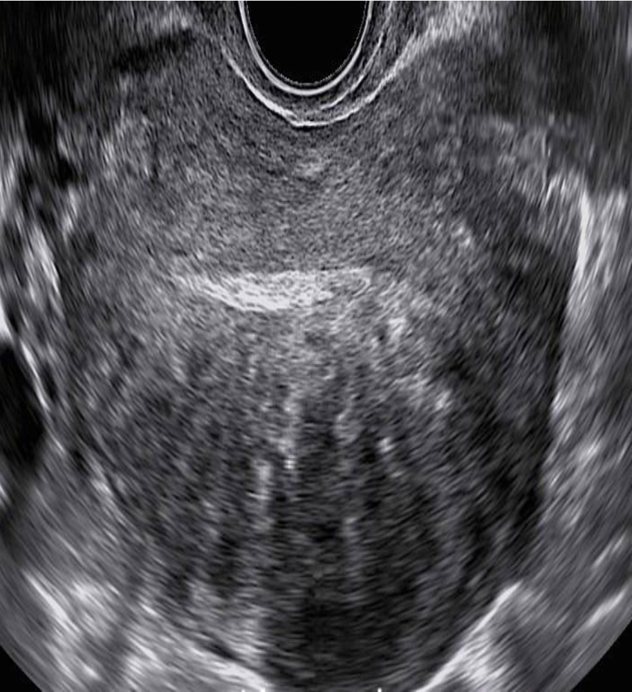 <p>A 47yr old patient presents with menorrhagia and mild midline, lower pelvic pain. The findings on the image are most suggestive of:</p><p>A. fibroid formation</p><p class="p1">B. leiomyosarcoma</p><p class="p1">C. hydatidiform mole</p><p class="p1">D. adenomyosis</p>