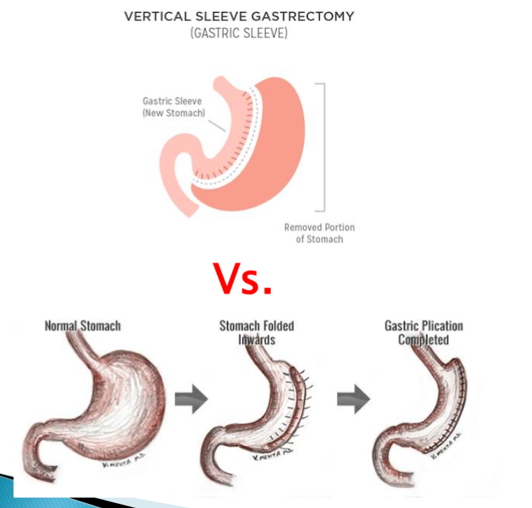 <p>Fold stomach so it is reversible. </p>