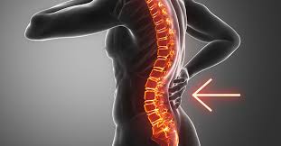 <p>Lordosis </p>