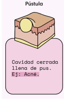 <p>pustula </p><p>-Ampolla que contiene fluido purulento.</p>