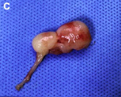 <p>Where does the long stock on the feline nasopharyngeal polyp normally extend?</p>