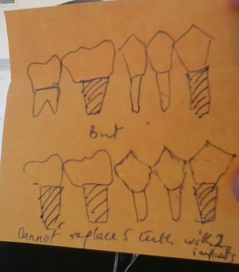 <p>We can use Canine, 1st molar and 2nd molar <br>(if only 4 missing we can use 2 implant at 33 and 36)</p><p></p>