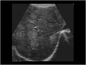 <ul><li><p>well defined hypo</p></li><li><p>well defined hyper </p></li><li><p>diffuse inhomogeneous exchotexture with no focal mass</p></li><li><p>bulls eye/target sing </p></li><li><p>hypo halo, hypo center</p></li></ul><p></p>