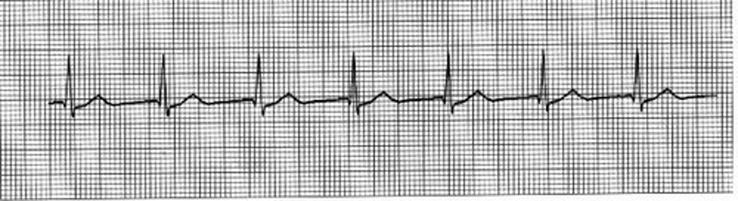 <p>if a process accelerates or if something accelerates it, it happens faster than usual or sooner than you expect; quickened</p>