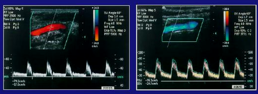 <p>True or False: The picture on the left shows an ICA flow pattern</p>