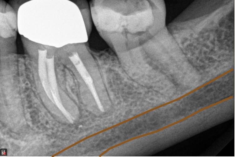 <p>What is this anatomical image you should see in a mandibular molar radiograph?</p>