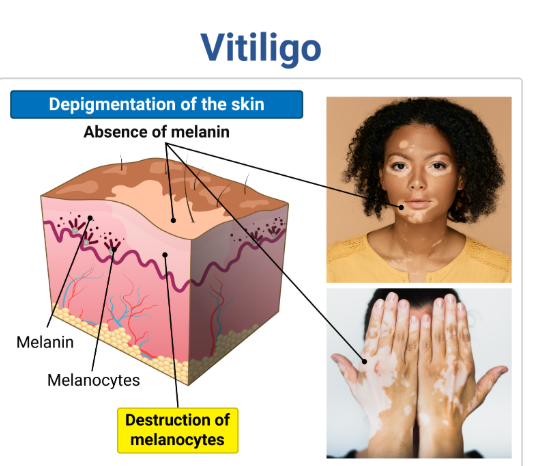 <p>vitiligo description</p>