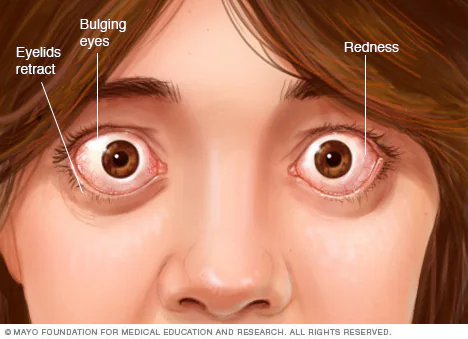 <p>Primary Hyperthyroidism</p>