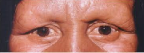 <p>¿Cuál es el tipo de lepra con infiltración difusa generalizada que en la cara de aspecto de mixedema o cara de luna, por la piel lisa, birllante y turgente?</p>