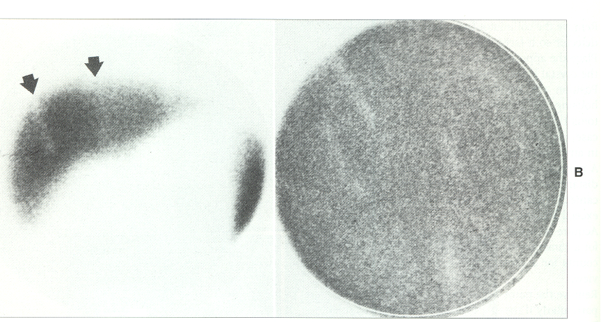 <p>The image on the right is an extrinsic flood image. What is the most likely cause of this defect?</p>