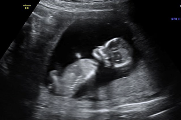 <ul><li><p>“eyeball” assessment of amount of fluid</p></li><li><p>no actual measurements</p></li><li><p>better used early in gestation</p></li><li><p>successful with more experienced sonographer</p><ul><li><p>leads to a more quantitative assessment</p></li></ul></li></ul><p></p>