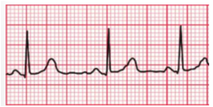 <p><span style="background-color: transparent;">Quina és la freqüència cardíaca d9aquest electrocardiograma?</span></p><p></p><p><span style="background-color: transparent;">a) 120 bpm /lpm </span></p><p><span style="background-color: transparent;">b) 100 bpm / lpm </span></p><p><span style="background-color: transparent;">c) 80 bpm /lpm </span></p><p><span style="background-color: transparent;">d) 60 bpm / lpm </span></p>
