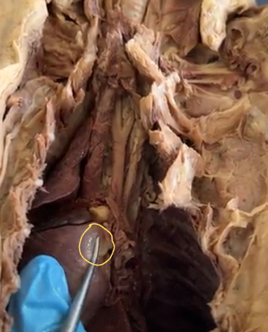 <p>pulmonary arteries</p>