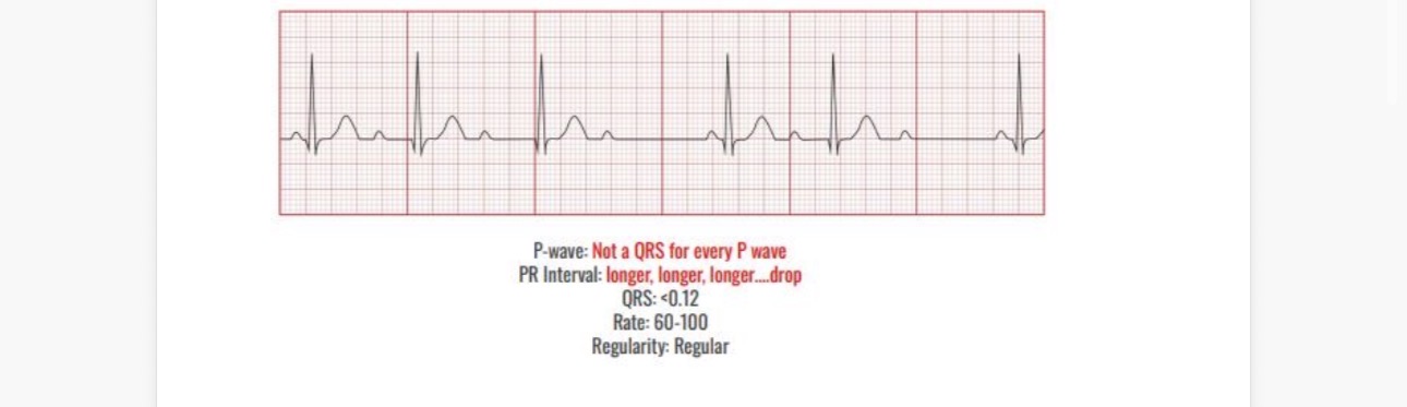 <p>Causes</p><p>Ischemia</p><p>Myocarditis </p><p>Post cardiac surgery</p><p></p><p>Interventions</p><p>Asymptomatic- no treatment </p><p>Symptomatic - pacing </p>