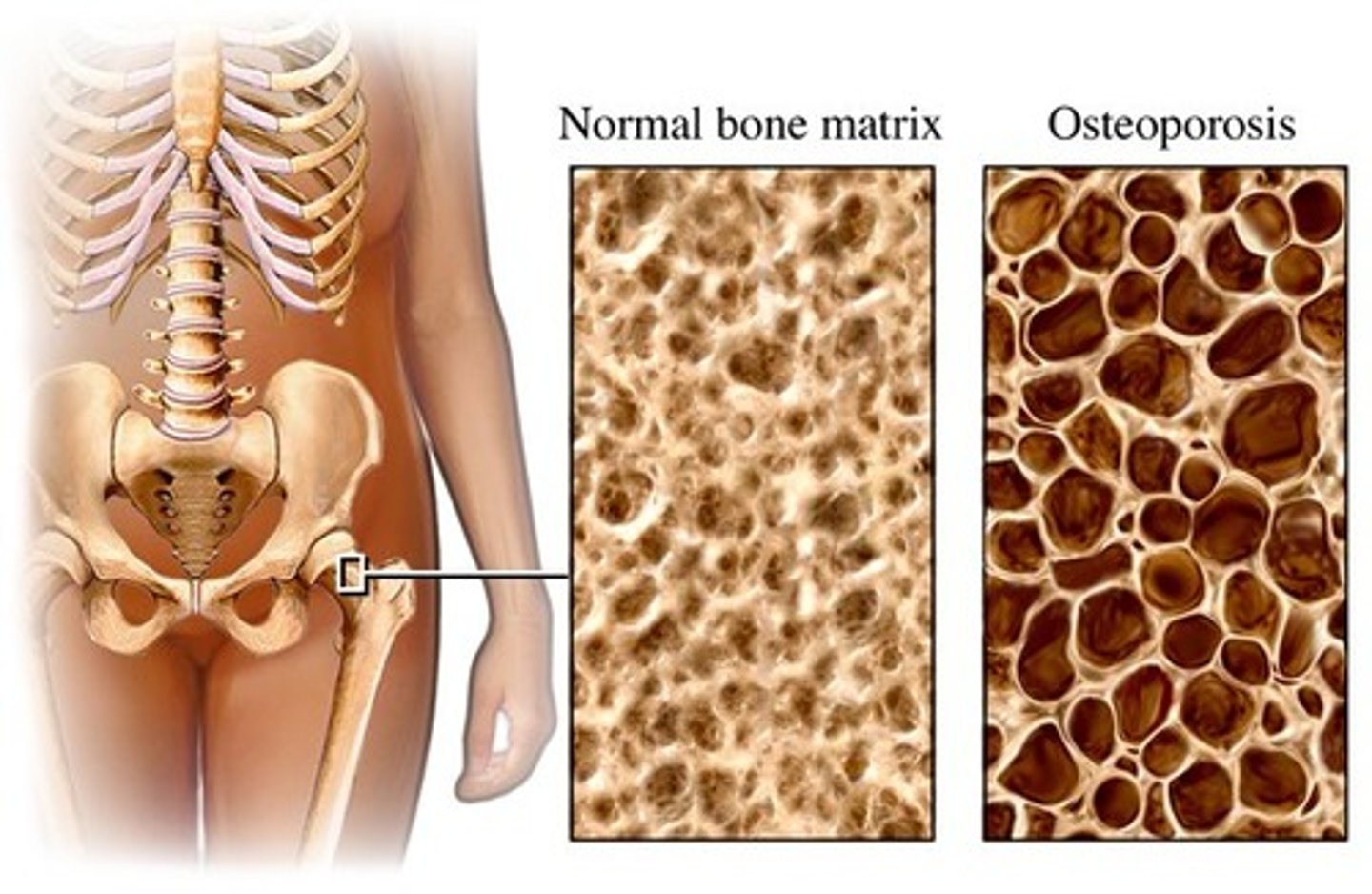 <p>During the aging process (60+), the organic and inorganic components of bone decrease = reductio in bone quality and atrophy of skeletal tissue, bones become brittle and easily fracture. Assessed via bone scanning.</p>