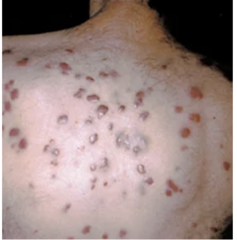 <p>is caused by human herpesvirus-8 (HHV-8)</p><p>Affects eight times more men than women and may spread through sexual contact.</p><p>Type of cancer that forms in the skin, lymph nodes, or internal organs; usually involves the epithelial layer of blood and lymphatic vessels.</p><p>AIDS-related KS exhibits a variable and aggressive course, ranging from localized cutaneous lesions to disseminated disease involving multiple organ systems.</p><p>- Requires frequent skin assessments for infections</p><p>-- Provide skin care</p><p>- Assess for purple, red, brown lesions on the skin or mouth</p>