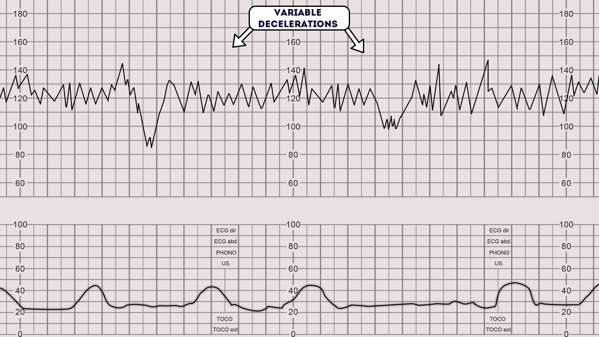 <p>sudden <span style="color: rgb(69, 111, 242);"><strong>DROP </strong></span>in FHR (looks like U,V,W)</p><ul><li><p>caused by <span style="color: rgb(72, 87, 211);"><strong>umbilical cord compression</strong></span>→ change position!!</p></li></ul><p></p>