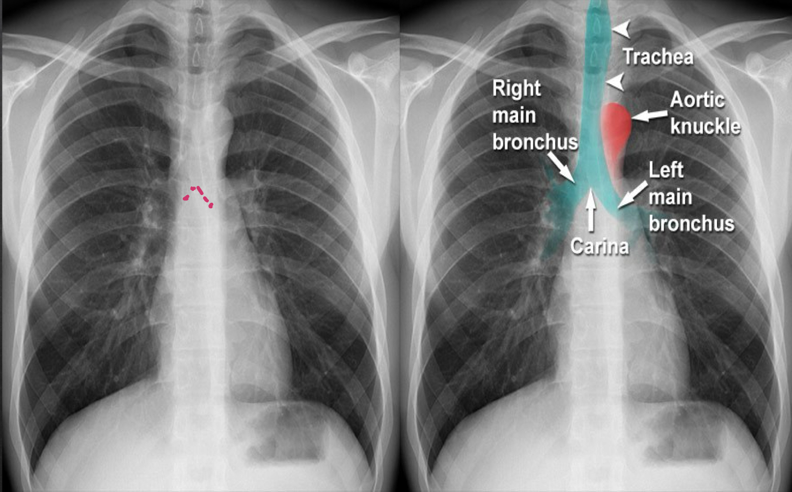 <ul><li><p>trachea: look for deviation other than aortic knob </p></li><li><p>bronchi: should be visible</p></li><li><p>carina: should be visible </p></li></ul><p></p>