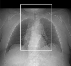 <p>Start location: 7 cm below the carina End location: 1 cm above the epiglottis</p>