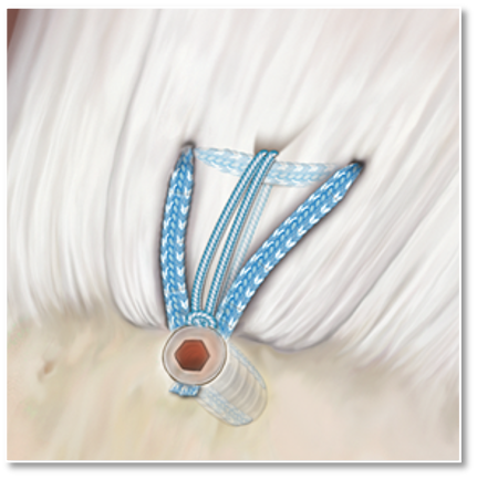 <p>Knotless repair with SpeedFix and/or RipStop</p>