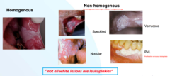 <p>Erythroleukoplakia</p><p>Verrucous</p><p>Nodular/granular</p><p>Ulcerated</p><p>****GREATEST RISK FOR CANCER****</p>
