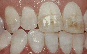 <p>ingestion of excess amount of fluoride, retention of amelogenin protein in enamel, hypomineralization creating chalky white areas, must be bilateral symmetrical distribution with previous exposure to Fl </p>