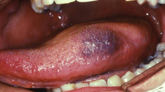 <p>accumulation of blood within tissue producing a mass </p>