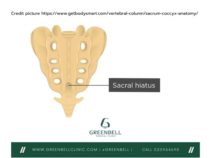 <ul><li><p>sacral hiatus is the opening that leads to sacral/vertebral canal</p></li><li><p>we have it bc there is no lamina or spinous process at S5</p></li></ul><p></p>