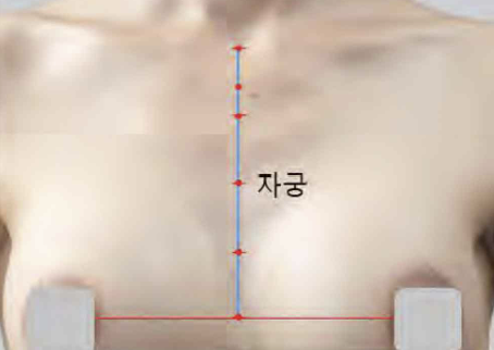 <p>앞정중선 위, 2째 갈비사이공간 높이</p>