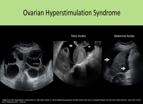 <p>D. ovarian hyperstimulation syndrome</p><p>The image demonstrates ascites with fluid in the Morison pouch. It is a common finding with ovarian hyperstimulation syndrome, Meigs syndrome and Fitz Hugh Curtis syndrome.</p>