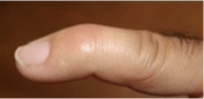 <p>What type of fracture is shown in the image?</p>