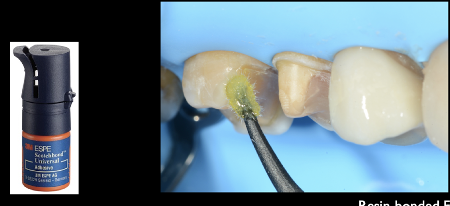 <p>bonding application protocol for scotchbond after etching </p>