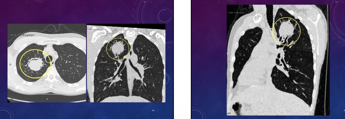 <p>What does ct show</p>