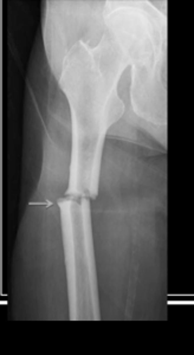 <p>Fx line @ 90º angle to long axis of bone</p>