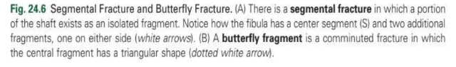 <p>segmental fracture - comminuted fracture</p>