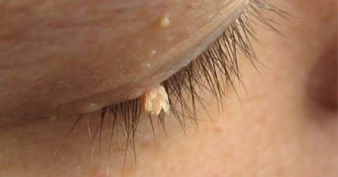 <ul><li><p><span><strong>Etiología:</strong> Infección por el Virus del Papiloma Humano (VPH-2 y VPH-4).</span></p></li><li><p><span><strong>Clínica:</strong> Pápula o nódulo hiperqueratósico de color grisáceo o marrón con pequeños puntos negros en la superficie.</span></p></li><li><p><span><strong>Tratamiento:</strong> Exéresis o electrocauterización.</span></p></li></ul><p></p>
