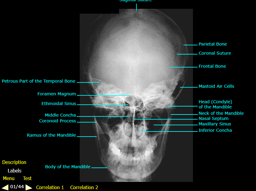 <ol start="8"><li><p>Inferior Concha</p></li><li><p>Maxillary Sinus</p></li><li><p>Nasal Septum</p></li><li><p>Neck of the Mandible</p></li><li><p>Head of the Mandible</p></li></ol><p></p>