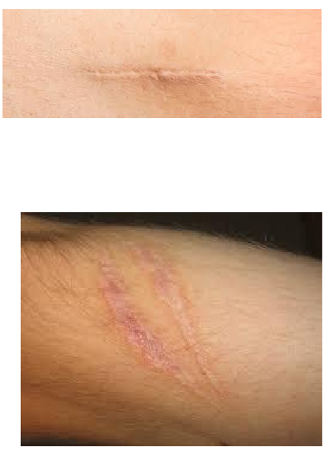 <p>What kind of lesion is this?</p>