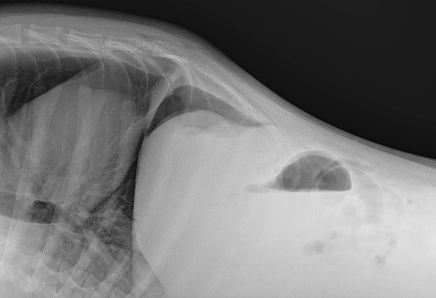 <p>What 2 things can be seen in this horizontal beam radiograph</p>