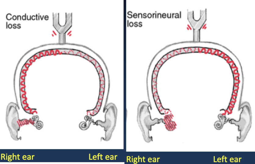 <ul><li><p><span style="background-color: transparent;">Option 1: Suggests unilateral conductive hearing loss in the right ear</span></p><ul><li><p><span style="background-color: transparent;">Conductive hearing loss increases the amplitude of bone-conducted sound reaching the cochlea</span></p></li></ul></li><li><p>Option 2: Suggests unilateral sensorineural hearing loss in the left ear</p><ul><li><p><span style="background-color: transparent;">The sound reaching the ear with sensorineural hearing loss will be perceived as softer than the other ear</span></p></li></ul></li><li><p>Further testing will be needed to determine the type of hearing loss</p></li></ul><p></p>