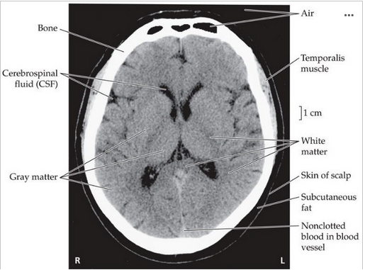 <p><span>A) What type of brain scan is pictured below (CT or MRI)? (2 points)</span></p><p><span>B) What would be an advantage of using this type of scan with contrast? What information would it provide? (3 points)</span></p><p></p>